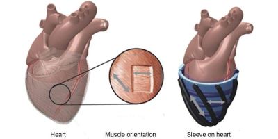 A prototype robotic sleeve, which can wrap around a weak heart before synchronising with its natural motion to help it keep beating, has been developed by an international team of engineers.