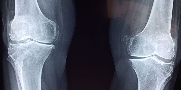 Knee implants designed to better fit individual patients